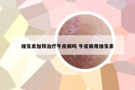 維生素加鐵治療牛皮癬嗎 牛皮癬用維生素