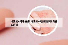 維生素e對牛皮癬 維生素e對膽固醇高有什么影響