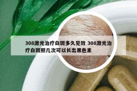 308激光治療白斑多久見效 308激光治療白斑照幾次可以長(zhǎng)出黑色素