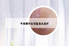 牛皮癬什么引起怎么治療