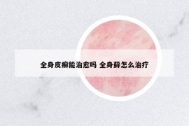 全身皮癬能治愈嗎 全身蘚怎么治療