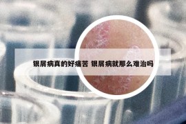 銀屑病真的好痛苦 銀屑病就那么難治嗎