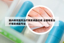 國內(nèi)哪家醫(yī)院治療銀屑病最權(quán)威 全國哪里治療銀屑病最專業(yè)