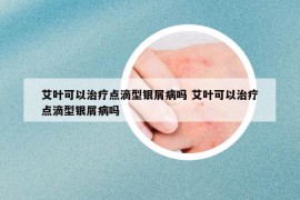 艾葉可以治療點滴型銀屑病嗎 艾葉可以治療點滴型銀屑病嗎