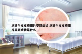 點滴牛皮皮癬圖片早期癥狀 點滴牛皮皮癬圖片早期癥狀是什么