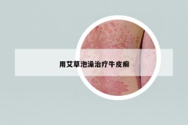 用艾草泡澡治療牛皮癬