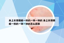 身上長得跟癬一樣的一塊一塊的 身上長得跟癬一樣的一塊一塊的怎么回事