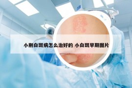 小剛白斑病怎么治好的 小白斑早期圖片