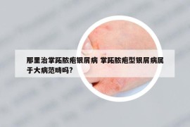 那里治掌跖膿皰銀屑病 掌跖膿皰型銀屑病屬于大病范疇嗎?