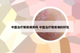 中醫(yī)治療銀屑病貴嗎 中醫(yī)治療銀屑病的好處