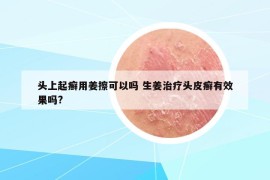 頭上起癬用姜擦可以嗎 生姜治療頭皮癬有效果嗎?