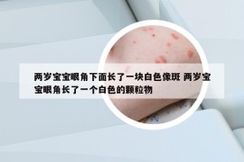兩歲寶寶眼角下面長了一塊白色像斑 兩歲寶寶眼角長了一個白色的顆粒物