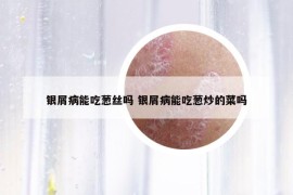 銀屑病能吃蔥絲嗎 銀屑病能吃蔥炒的菜嗎