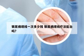 銀屑病埋線一次多少錢 銀屑病埋線療法能治嗎?