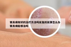 銀肖病有好的治療方法嗎反復(fù)的反彈怎么辦 銀肖病能根治嗎