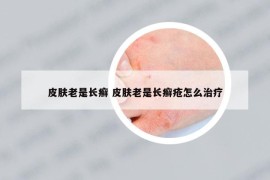 皮膚老是長癬 皮膚老是長癬瘡怎么治療