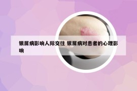 銀屑病影響人際交往 銀屑病對患者的心理影響