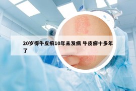 20歲得牛皮癬10年未發(fā)病 牛皮癬十多年了