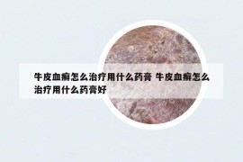 牛皮血癬怎么治療用什么藥膏 牛皮血癬怎么治療用什么藥膏好