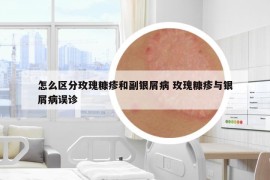 怎么區(qū)分玫瑰糠疹和副銀屑病 玫瑰糠疹與銀屑病誤診