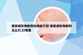 銀屑病生物制劑在哪能打到 銀屑病生物制劑怎么打,打哪里
