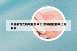 銀屑病首先出現(xiàn)在指甲上 銀屑病在指甲上先發(fā)病