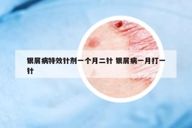 銀屑病特效針劑一個月二針 銀屑病一月打一針