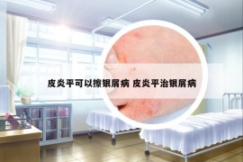 皮炎平可以擦銀屑病 皮炎平治銀屑病