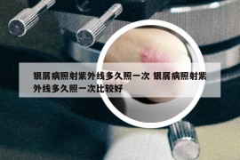 銀屑病照射紫外線多久照一次 銀屑病照射紫外線多久照一次比較好