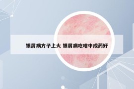 銀屑病方子上火 銀屑病吃啥中成藥好