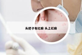 頭把子有紅癬 頭上紅癬