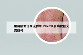 銀屑病微信交流群號 2020銀屑病微信交流群號