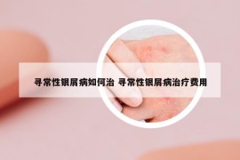 尋常性銀屑病如何治 尋常性銀屑病治療費用