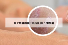 臉上銀屑病用什么藥膏 臉上 銀屑病
