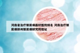 河南省治療銀屑病最好醫(yī)院排名 河南治療銀屑病鄭州銀屑病研究院地址