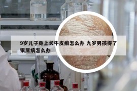 9歲兒子身上長牛皮癬怎么辦 九歲男孩得了銀屑病怎么辦
