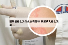 銀屑病身上為什么會(huì)有異味 銀屑病人身上發(fā)臭