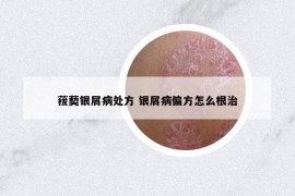 菝葜銀屑病處方 銀屑病偏方怎么根治