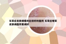 石家莊皮膚病看的比較好的醫(yī)院 石家莊哪家皮膚病醫(yī)院看病好