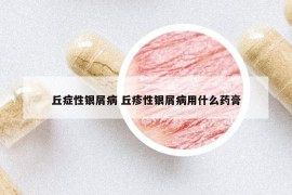 丘癥性銀屑病 丘疹性銀屑病用什么藥膏