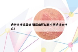 透析治療銀屑病 銀屑病可以用中醫(yī)透法治療嗎?
