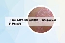 上海市中醫(yī)治療牛皮癬醫(yī)院 上海治牛皮膚癬的?？漆t(yī)院