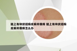 腿上有塊狀結(jié)痂皮癬并瘙癢 腿上有塊狀結(jié)痂皮癬并瘙癢怎么辦