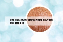 吃維生素c對治療銀屑病 吃維生素c對治療銀屑病有用嗎