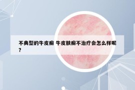 不典型的牛皮癬 牛皮膚癬不治療會(huì)怎么樣呢?