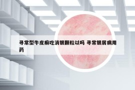 尋常型牛皮癬吃消銀顆粒以嗎 尋常銀屑病用藥