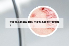 牛皮癬忌口蘑菇類嗎 牛皮癬不能吃什么水果?