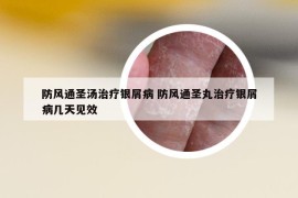 防風(fēng)通圣湯治療銀屑病 防風(fēng)通圣丸治療銀屑病幾天見效