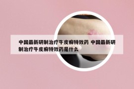 中國(guó)最新研制治療牛皮癬特效藥 中國(guó)最新研制治療牛皮癬特效藥是什么