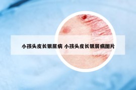 小孩頭皮長銀屑病 小孩頭皮長銀屑病圖片